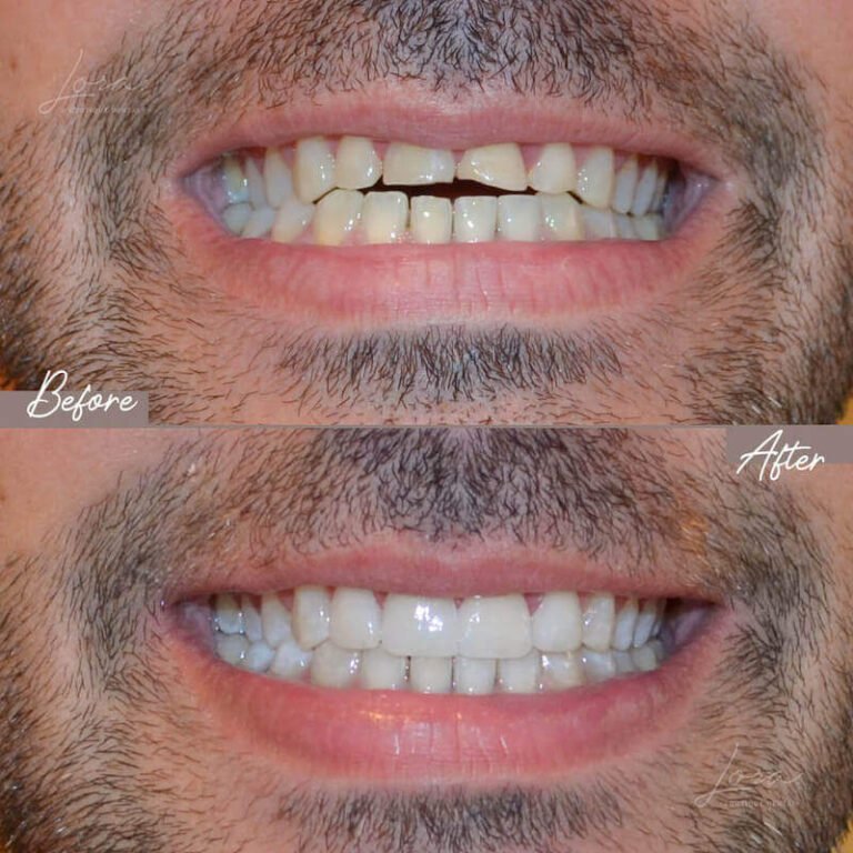 Home 02 caso estetica carillas porcelana barcelona